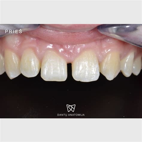Antakių laminavimo rezultatas prieš ir po